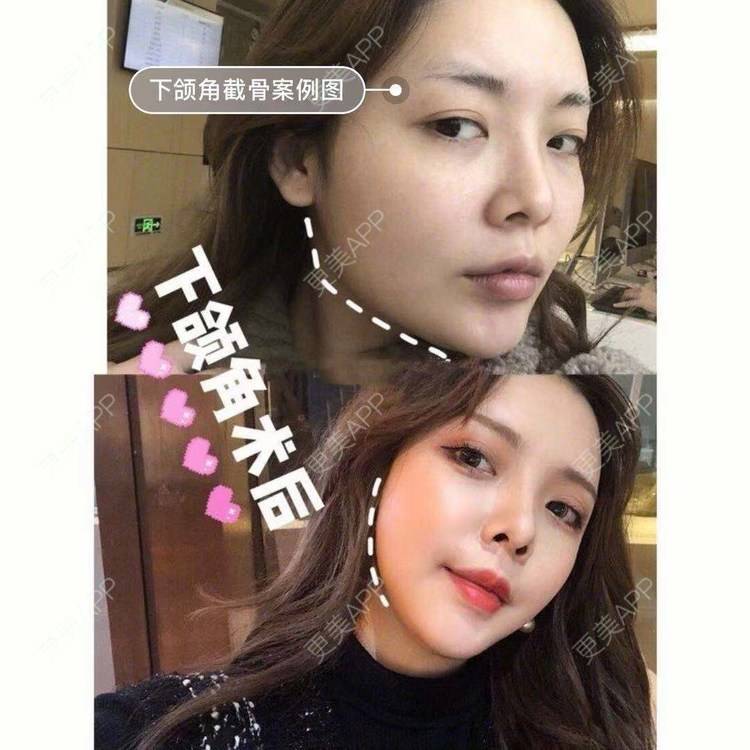 更美 - GH更美cc_的颧骨内推经验 | 颧弓降低 | 颧骨填充 | 颧骨提高 | 颧骨内推 | 上海