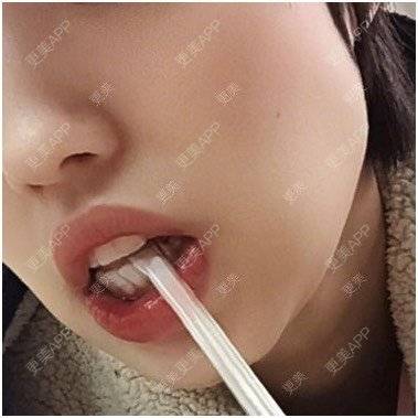 更美 - 脸猫爱吃鱼仍的错颌锁颌经验 | 错颌锁颌 | 台州