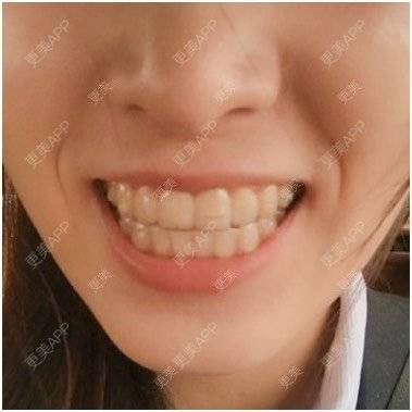 更美 - 我密码里的你梦的错颌锁颌经验 | 隐形牙齿矫正 | 错颌锁颌 | 冷光美白 | 台州