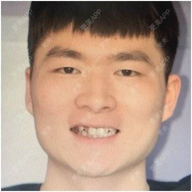 更美 - 很怀恋我俩的爱情戏的冷光美白经验 | 隐形牙齿矫正 | 牙齿瓷贴面 | 冷光美白 | 台州