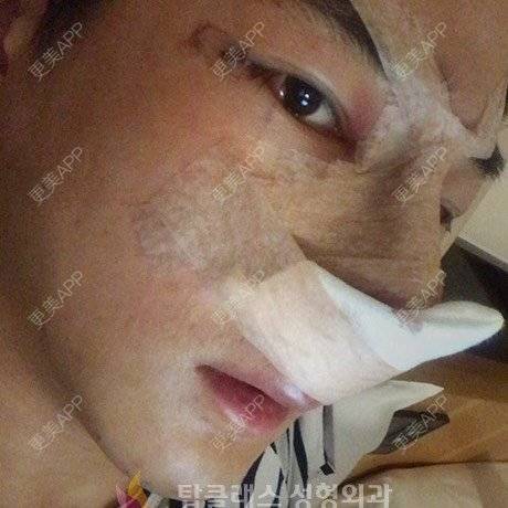 更美 - 更美用户LQ1JNnex6u的隆鼻经验 | 隆鼻 | 驼峰鼻矫正 | 鼻部多项 | 鼻小柱延长 | 鹰钩鼻矫正 | 武汉