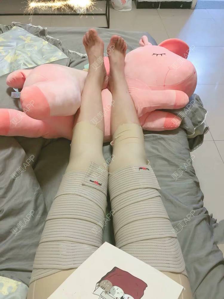 更美 - 更美用户10xPXmQisV的吸脂瘦大腿经验 | 临汾 | 吸脂瘦大腿