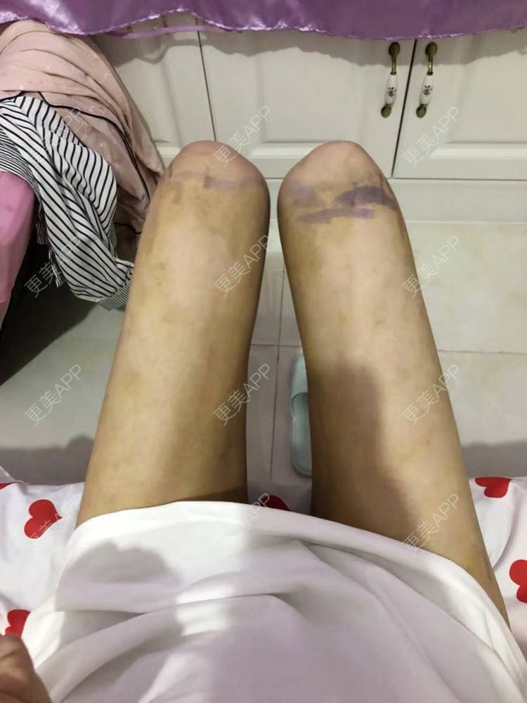 更美 - 更美用户10xPXmQisV的吸脂瘦大腿经验 | 临汾 | 吸脂瘦大腿