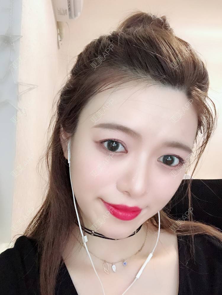 更美 - 倩倩吖的自体脂肪填充泪沟经验 | 自体脂肪丰苹果肌 | 自体脂肪面部填充 | 自体脂肪丰面颊 | 自体脂肪全面部填充 | 美白嫩肤 | 自体脂肪填充泪沟 | 武汉 | 视频日记