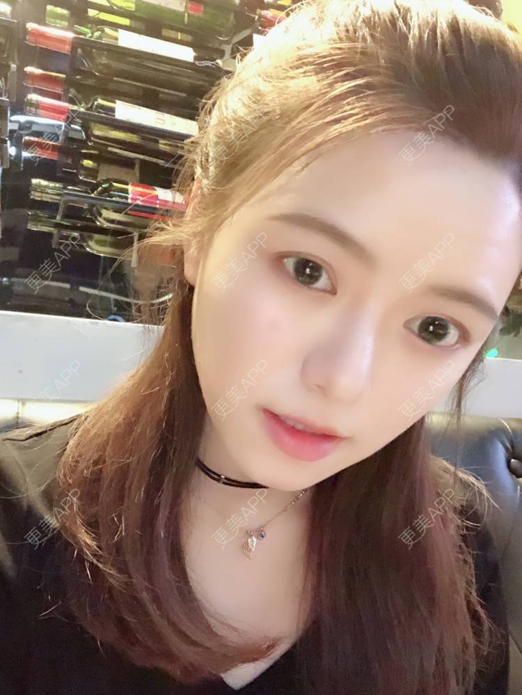 更美 - 倩倩吖的自体脂肪填充泪沟经验 | 自体脂肪丰苹果肌 | 自体脂肪面部填充 | 自体脂肪丰面颊 | 自体脂肪全面部填充 | 美白嫩肤 | 自体脂肪填充泪沟 | 武汉 | 视频日记