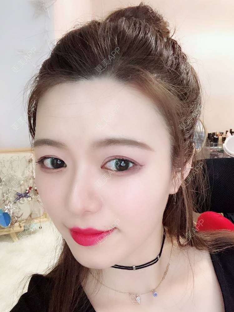 更美 - 倩倩吖的自体脂肪填充泪沟经验 | 自体脂肪丰苹果肌 | 自体脂肪面部填充 | 自体脂肪丰面颊 | 自体脂肪全面部填充 | 美白嫩肤 | 自体脂肪填充泪沟 | 武汉 | 视频日记