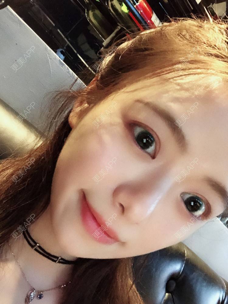 更美 - 倩倩吖的自体脂肪填充泪沟经验 | 自体脂肪丰苹果肌 | 自体脂肪面部填充 | 自体脂肪丰面颊 | 自体脂肪全面部填充 | 美白嫩肤 | 自体脂肪填充泪沟 | 武汉 | 视频日记
