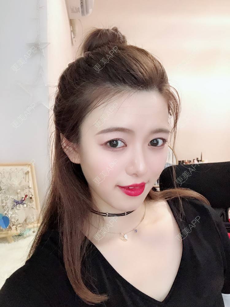 更美 - 倩倩吖的自体脂肪填充泪沟经验 | 自体脂肪丰苹果肌 | 自体脂肪面部填充 | 自体脂肪丰面颊 | 自体脂肪全面部填充 | 美白嫩肤 | 自体脂肪填充泪沟 | 武汉 | 视频日记