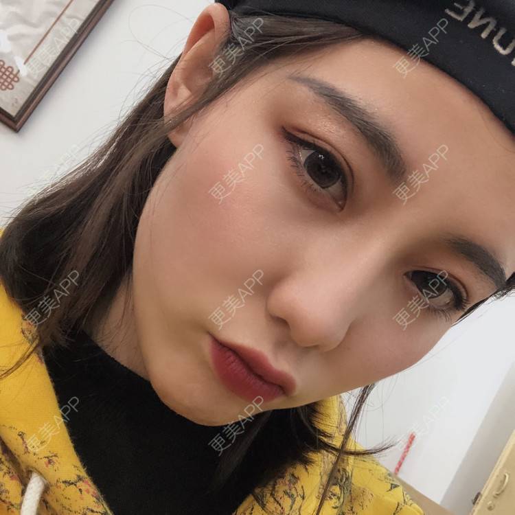 更美 - 四川悦好医学美容医院的吸脂瘦脸经验 | 吸脂瘦脸