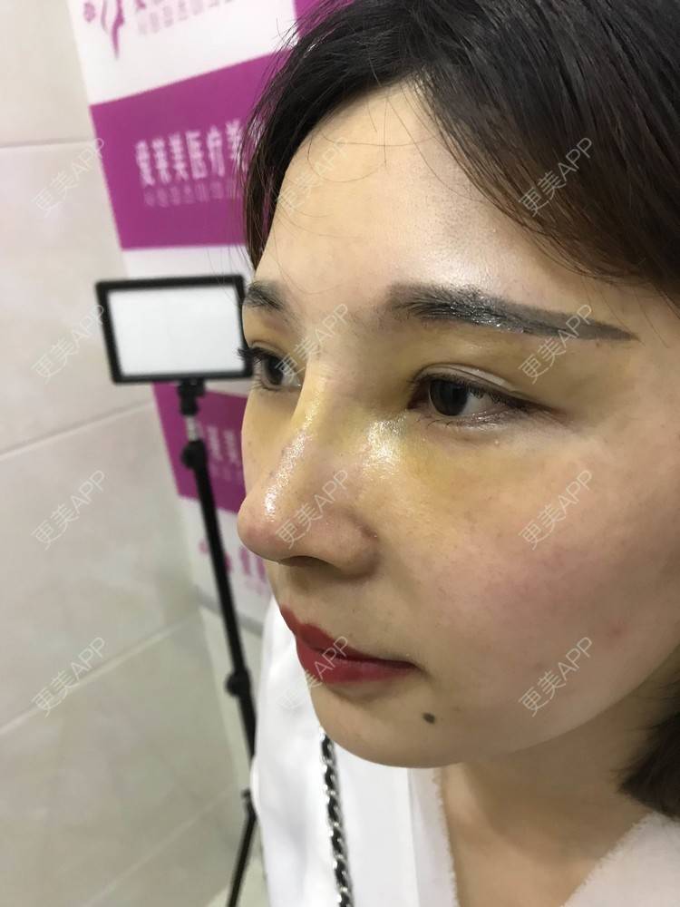更美 - 难得孤寂嘻的隆鼻经验 | 台州 | 隆鼻