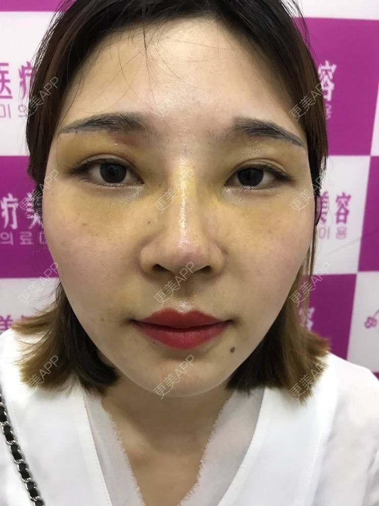 更美 - 难得孤寂嘻的隆鼻经验 | 台州 | 隆鼻