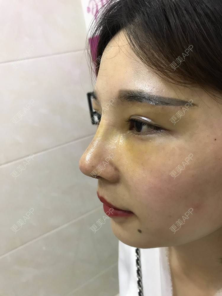 更美 - 难得孤寂嘻的隆鼻经验 | 台州 | 隆鼻
