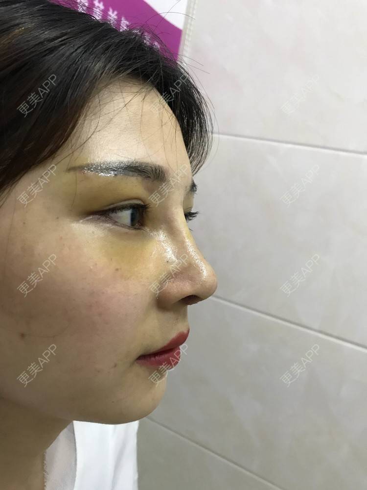 更美 - 难得孤寂嘻的隆鼻经验 | 台州 | 隆鼻