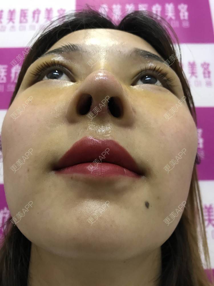 更美 - 难得孤寂嘻的隆鼻经验 | 台州 | 隆鼻