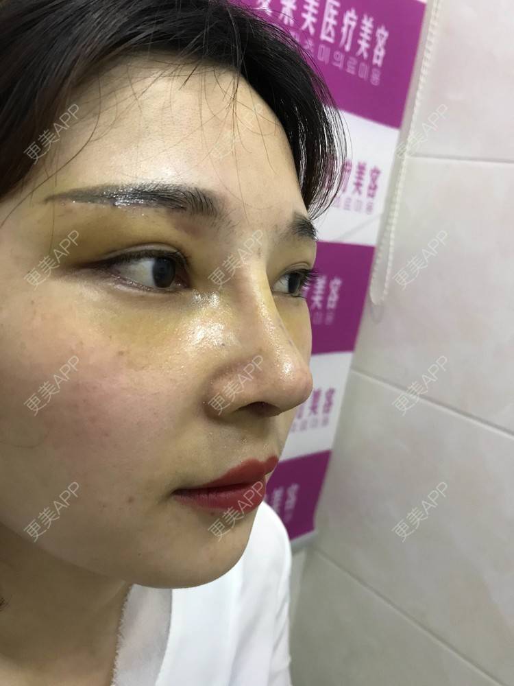更美 - 难得孤寂嘻的隆鼻经验 | 台州 | 隆鼻