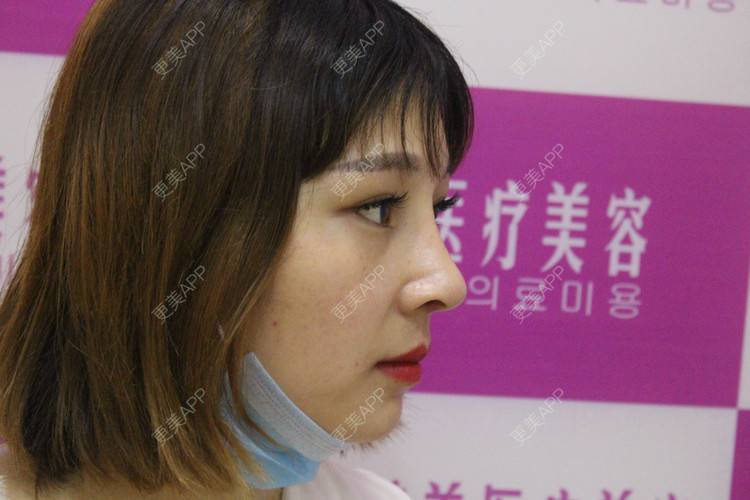 更美 - 难得孤寂嘻的隆鼻经验 | 台州 | 隆鼻