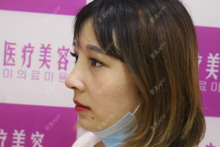 更美 - 难得孤寂嘻的隆鼻经验 | 台州 | 隆鼻