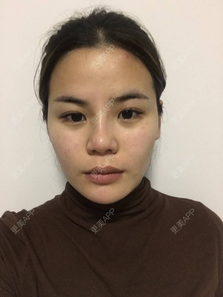 更美 - 四川悦好医学美容医院的自体脂肪全面部填充经验 | 自体脂肪全面部填充