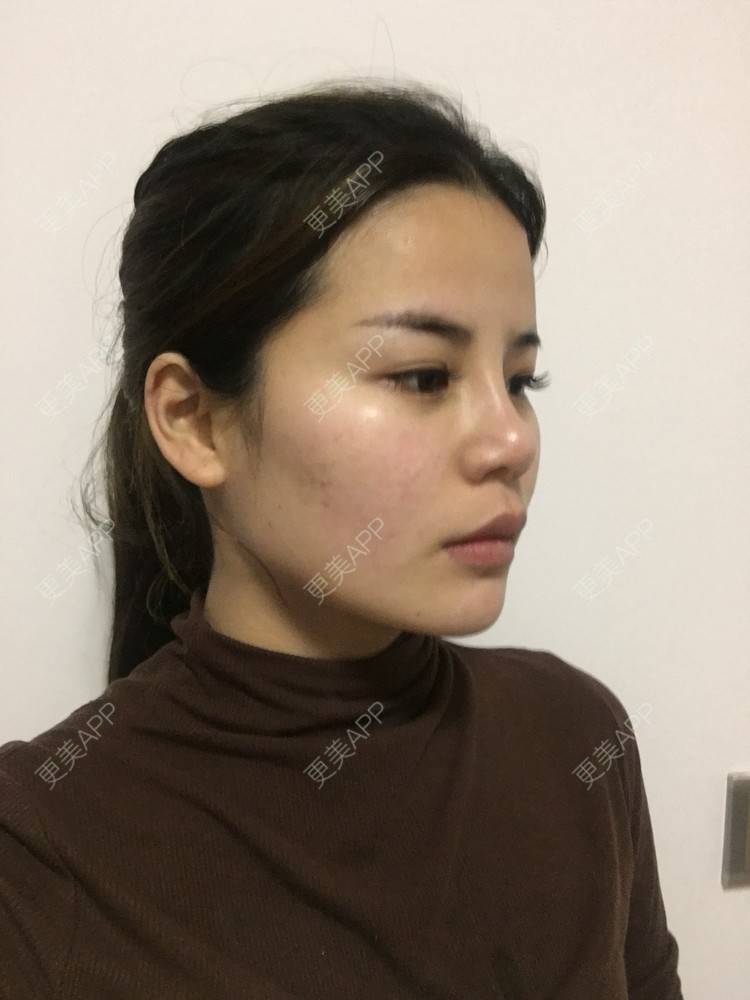 更美 - 四川悦好医学美容医院的自体脂肪全面部填充经验 | 自体脂肪全面部填充
