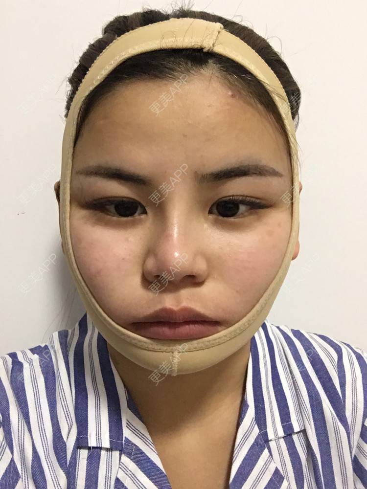 更美 - 四川悦好医学美容医院的自体脂肪全面部填充经验 | 自体脂肪全面部填充