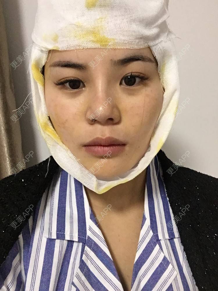 更美 - 四川悦好医学美容医院的自体脂肪全面部填充经验 | 自体脂肪全面部填充