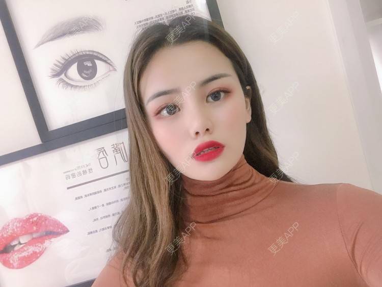 更美 - 四川悦好医学美容医院的自体脂肪全面部填充经验 | 自体脂肪全面部填充