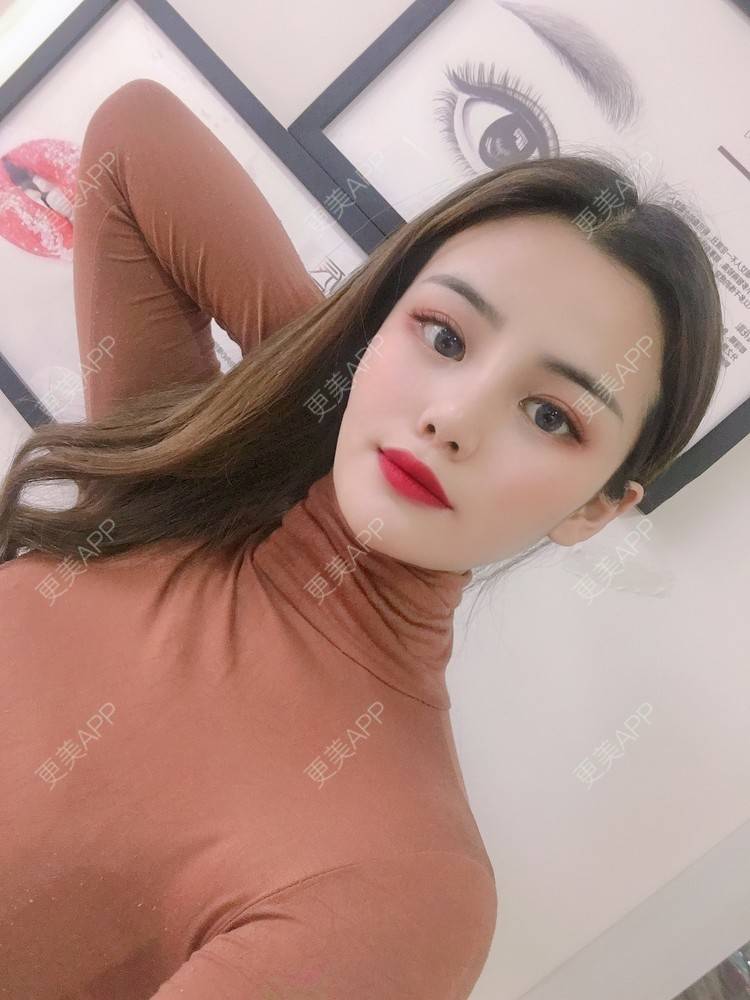 更美 - 四川悦好医学美容医院的自体脂肪全面部填充经验 | 自体脂肪全面部填充