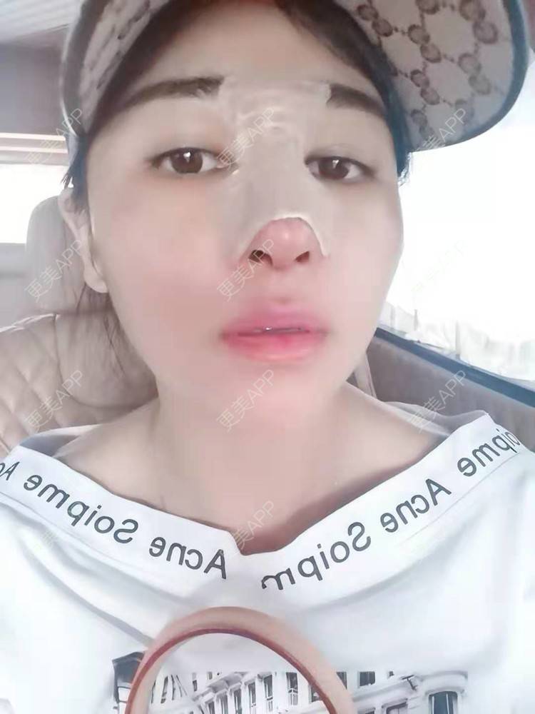 更美 - 白落落的隆鼻经验 | 台州 | 隆鼻