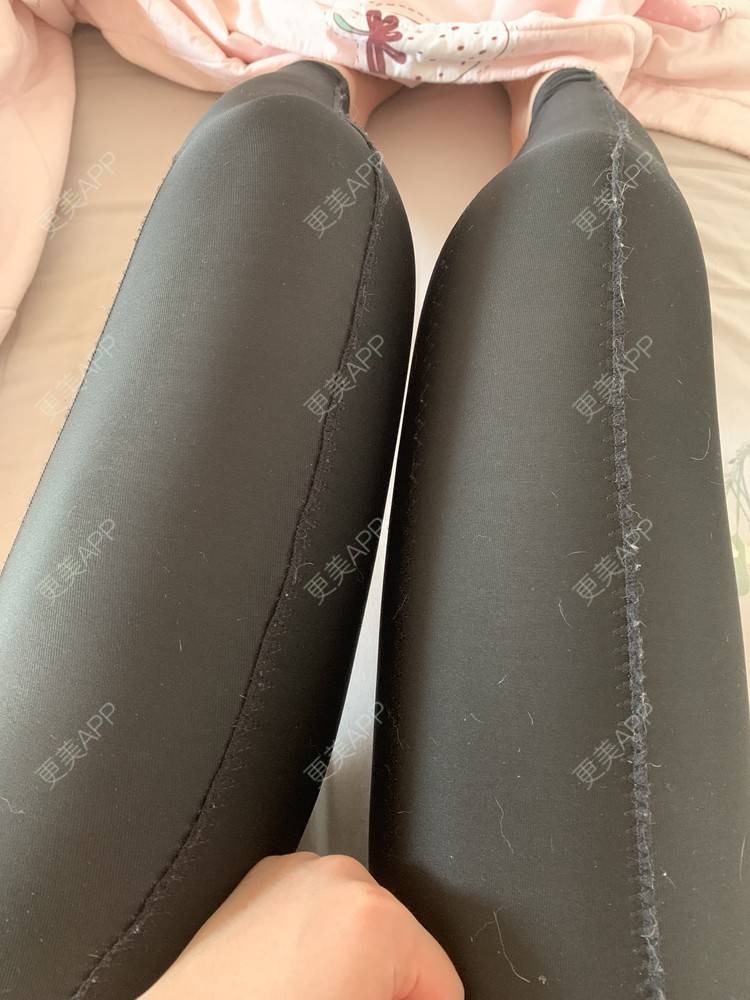 更美 - 更美用户JrJLC5yFo7的吸脂经验 | 吸脂 | 南京