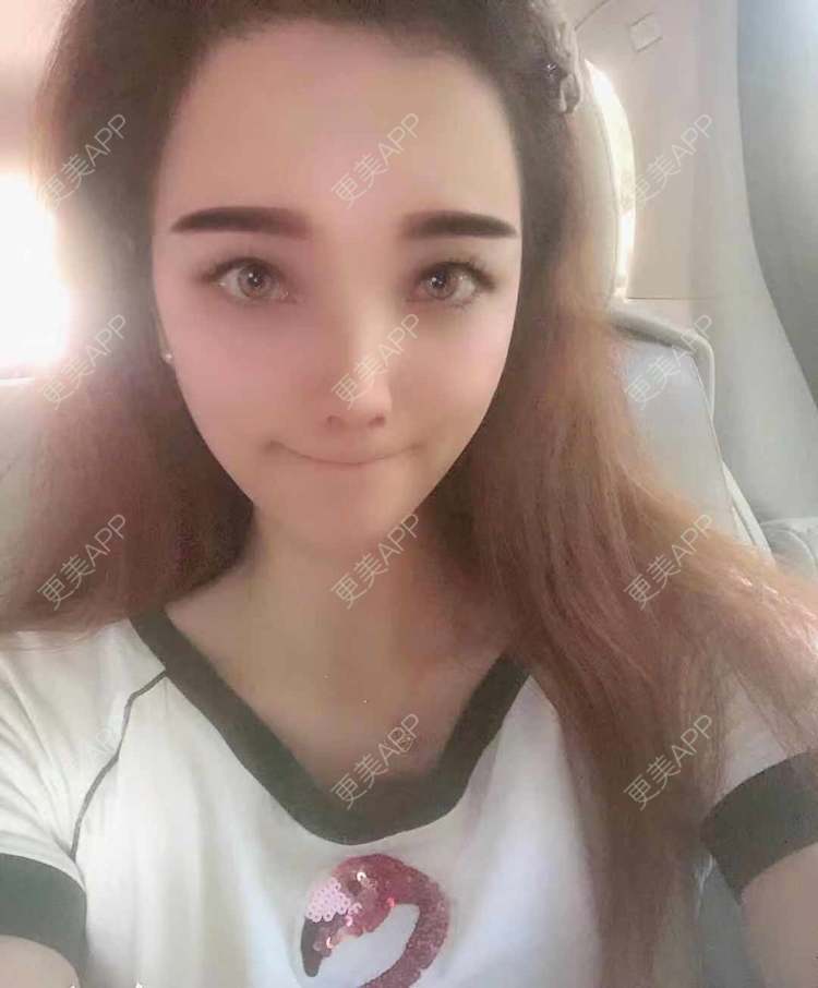 更美 - 更美用户EWqDuvHmIb的自体脂肪丰面颊经验 | 自体脂肪丰面颊 | 成都