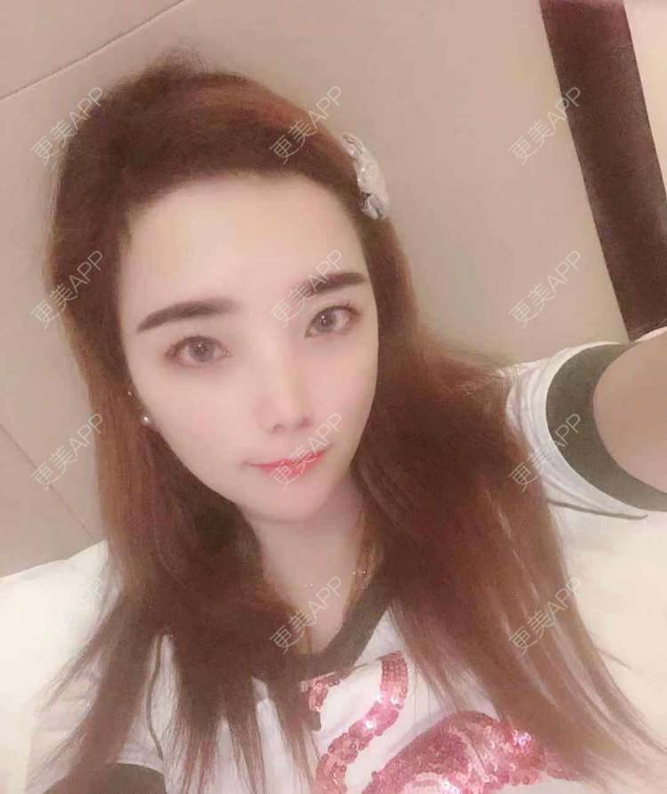 更美 - 更美用户EWqDuvHmIb的自体脂肪丰面颊经验 | 自体脂肪丰面颊 | 成都
