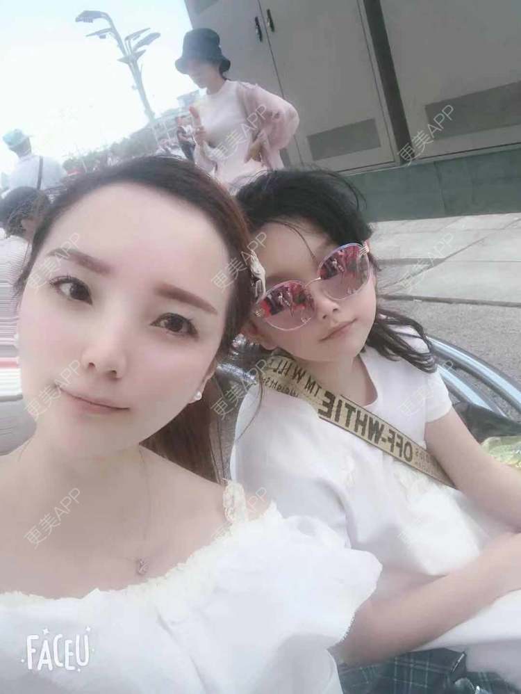 更美 - 更美用户EWqDuvHmIb的自体脂肪丰面颊经验 | 自体脂肪丰面颊 | 成都