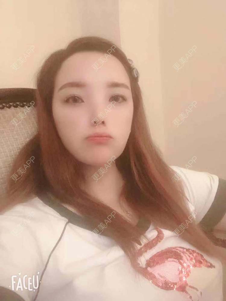 更美 - 更美用户EWqDuvHmIb的自体脂肪丰面颊经验 | 自体脂肪丰面颊 | 成都