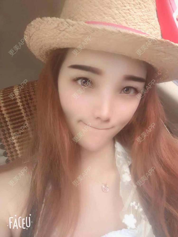更美 - 更美用户EWqDuvHmIb的自体脂肪丰面颊经验 | 自体脂肪丰面颊 | 成都