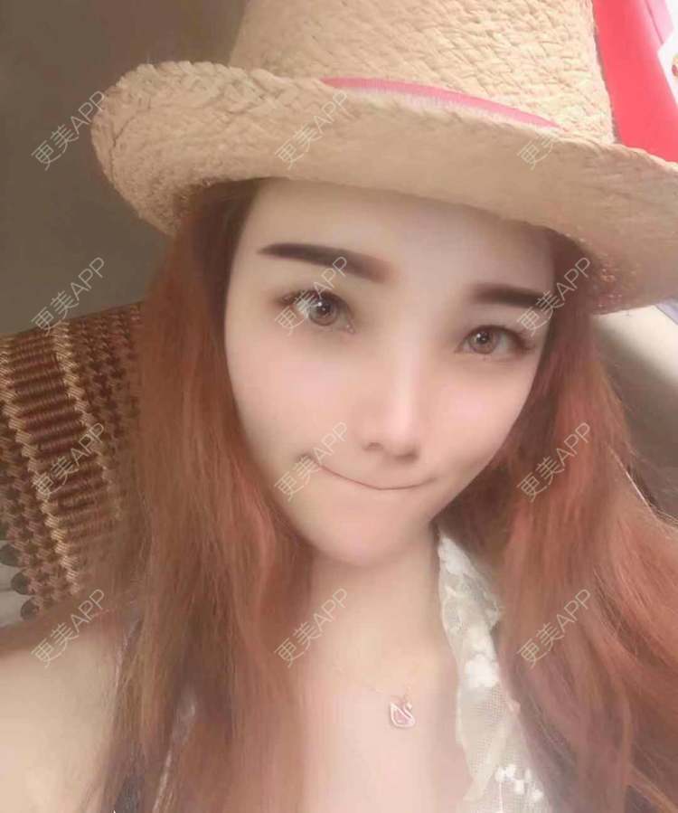 更美 - 更美用户EWqDuvHmIb的自体脂肪丰面颊经验 | 自体脂肪丰面颊 | 成都