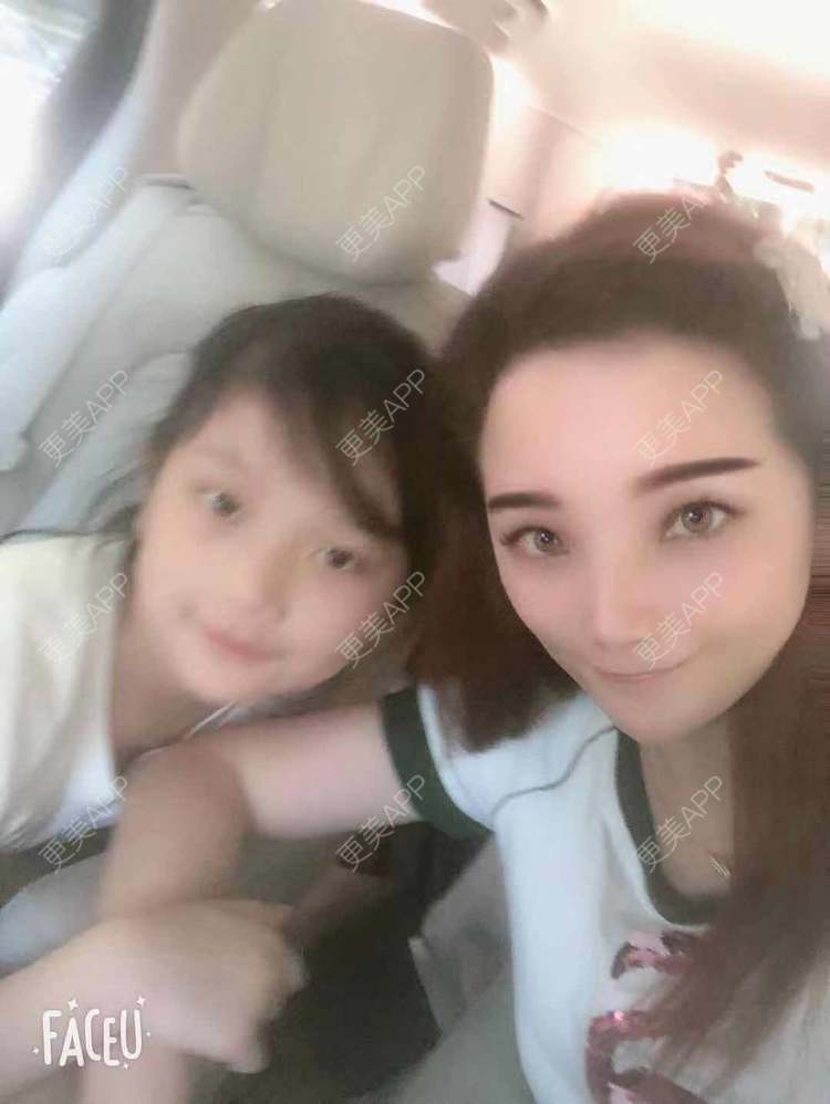 更美 - 更美用户EWqDuvHmIb的自体脂肪丰面颊经验 | 自体脂肪丰面颊 | 成都