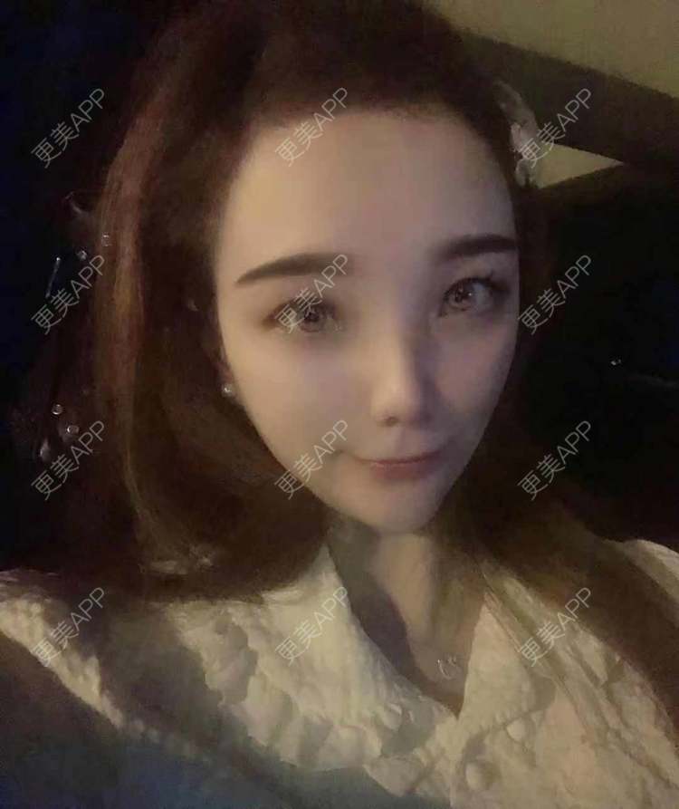 更美 - 更美用户EWqDuvHmIb的自体脂肪丰面颊经验 | 自体脂肪丰面颊 | 成都