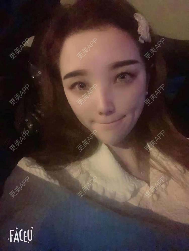 更美 - 更美用户EWqDuvHmIb的自体脂肪丰面颊经验 | 自体脂肪丰面颊 | 成都