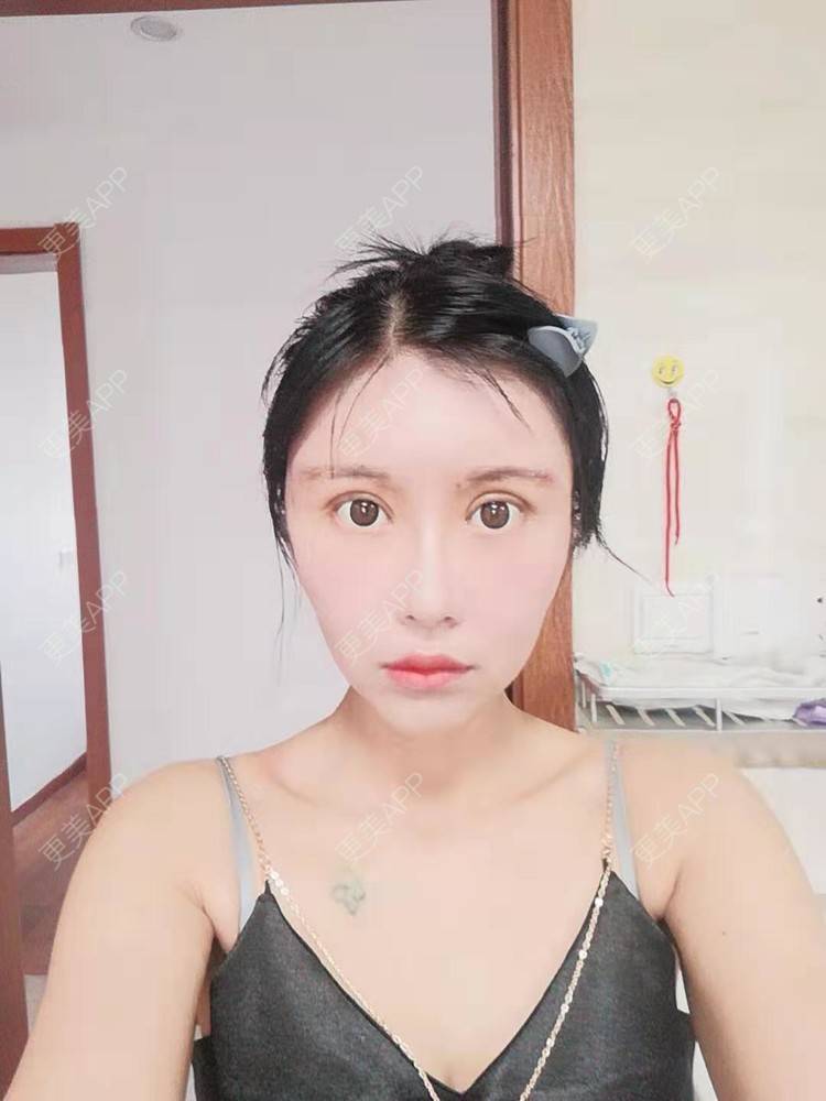 更美 - 更美用户Bckl5DpFZ4的膨体垫眉弓经验 | 膨体垫眉弓 | 垫眉弓 | 武汉