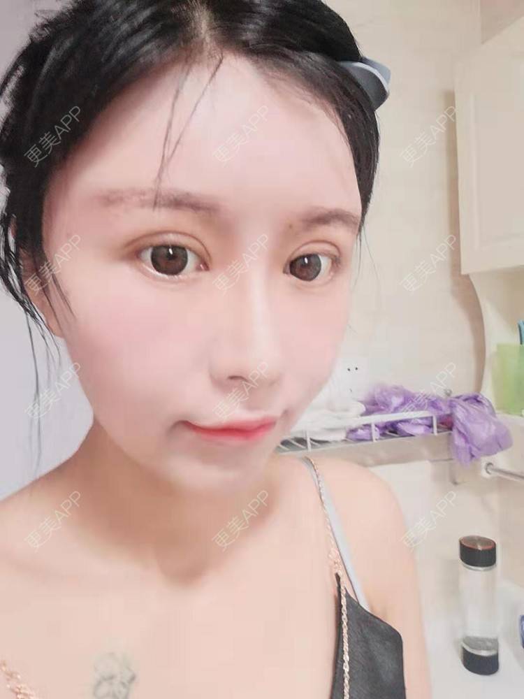 更美 - 更美用户Bckl5DpFZ4的膨体垫眉弓经验 | 膨体垫眉弓 | 垫眉弓 | 武汉