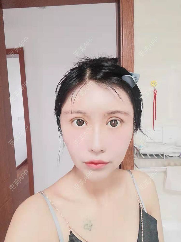 更美 - 更美用户Bckl5DpFZ4的膨体垫眉弓经验 | 膨体垫眉弓 | 垫眉弓 | 武汉