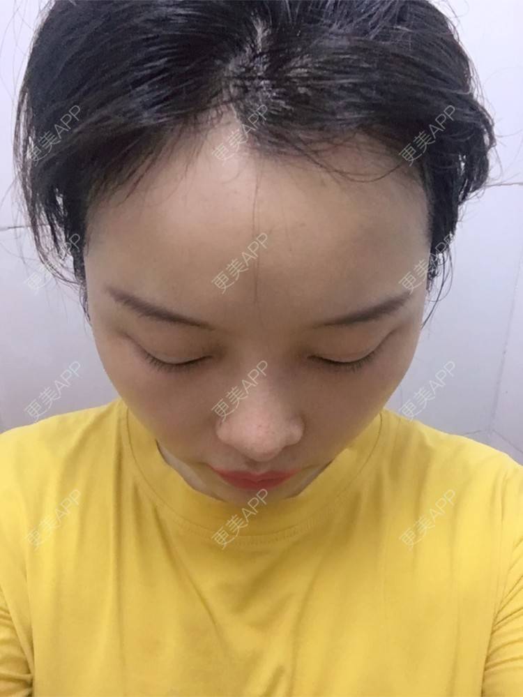 更美 - 更美用户qrxoreyTE2的玻尿酸溶解酶经验 | 玻尿酸溶解酶 | 重庆