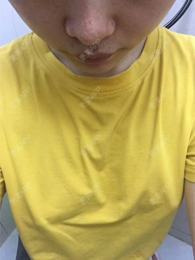 更美 - 更美用户qrxoreyTE2的玻尿酸溶解酶经验 | 玻尿酸溶解酶 | 重庆