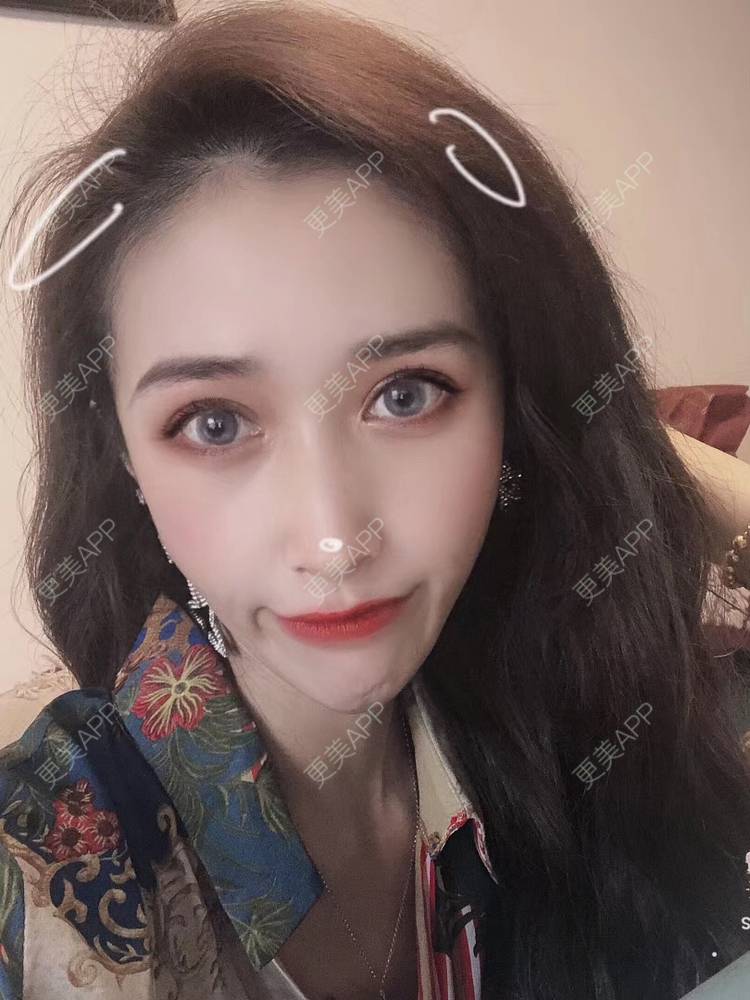 更美 - 丢了灵魂的孩纸的唇腭裂修复经验 | 厚唇改薄 | 唇腭裂修复 | 玻尿酸唇部 | 自体脂肪丰唇 | 胶原蛋白丰唇