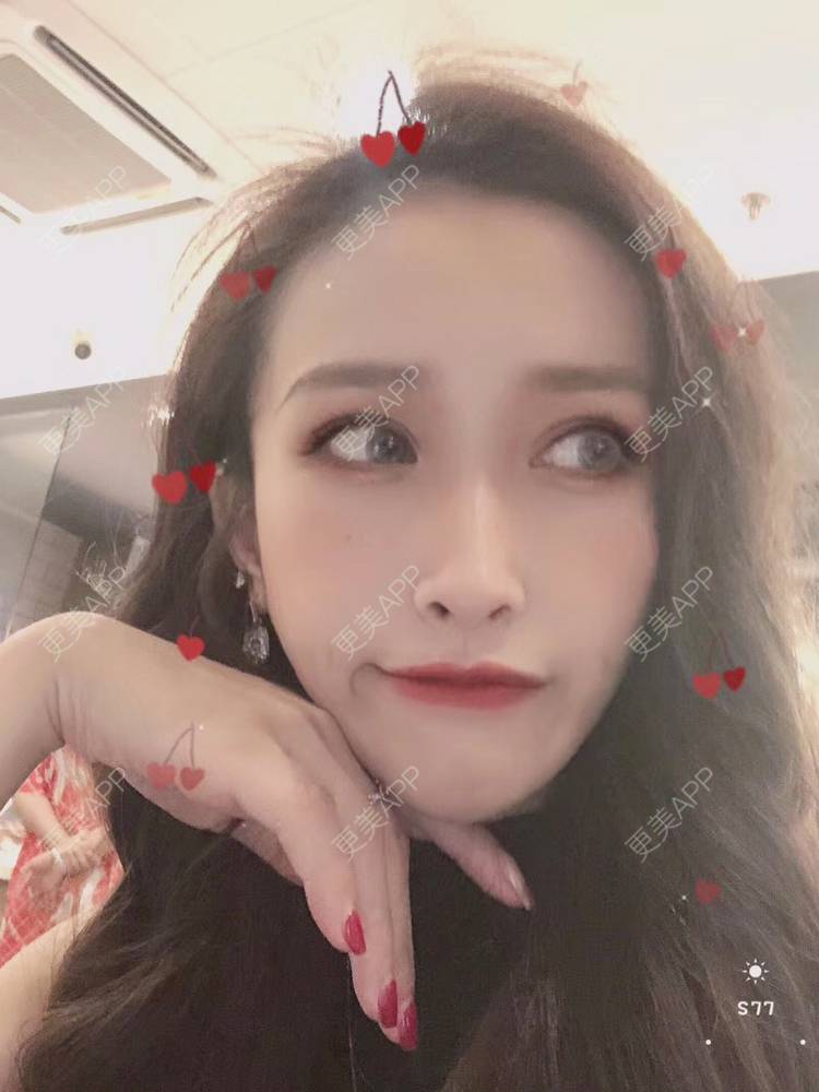 更美 - 丢了灵魂的孩纸的唇腭裂修复经验 | 厚唇改薄 | 唇腭裂修复 | 玻尿酸唇部 | 自体脂肪丰唇 | 胶原蛋白丰唇