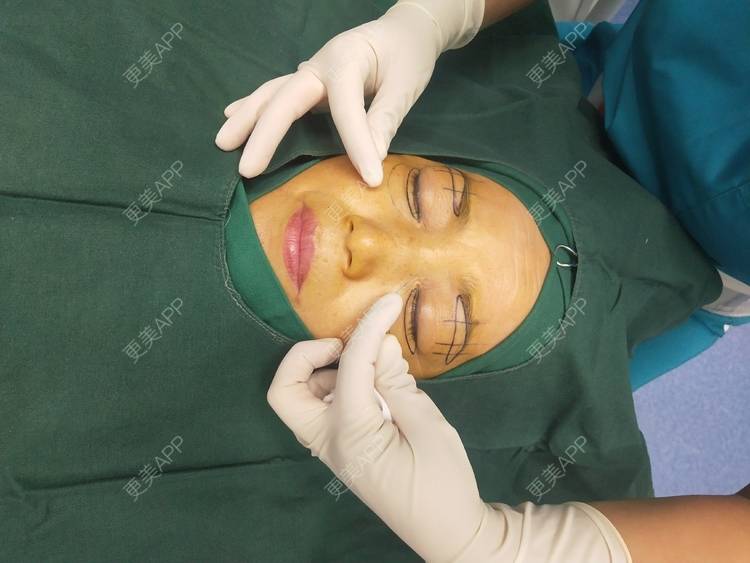 切眉手术过程图片