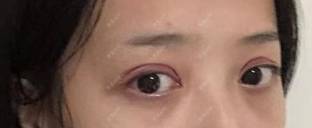 更美 - 幻象重生的全切双眼皮经验 | 全切双眼皮 | 南宁