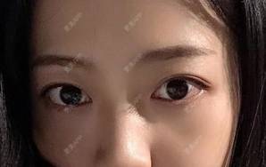 更美 - 幻象重生的全切双眼皮经验 | 全切双眼皮 | 南宁