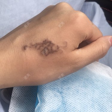 更美用户gmzv8sr1pi的激光洗纹身日记