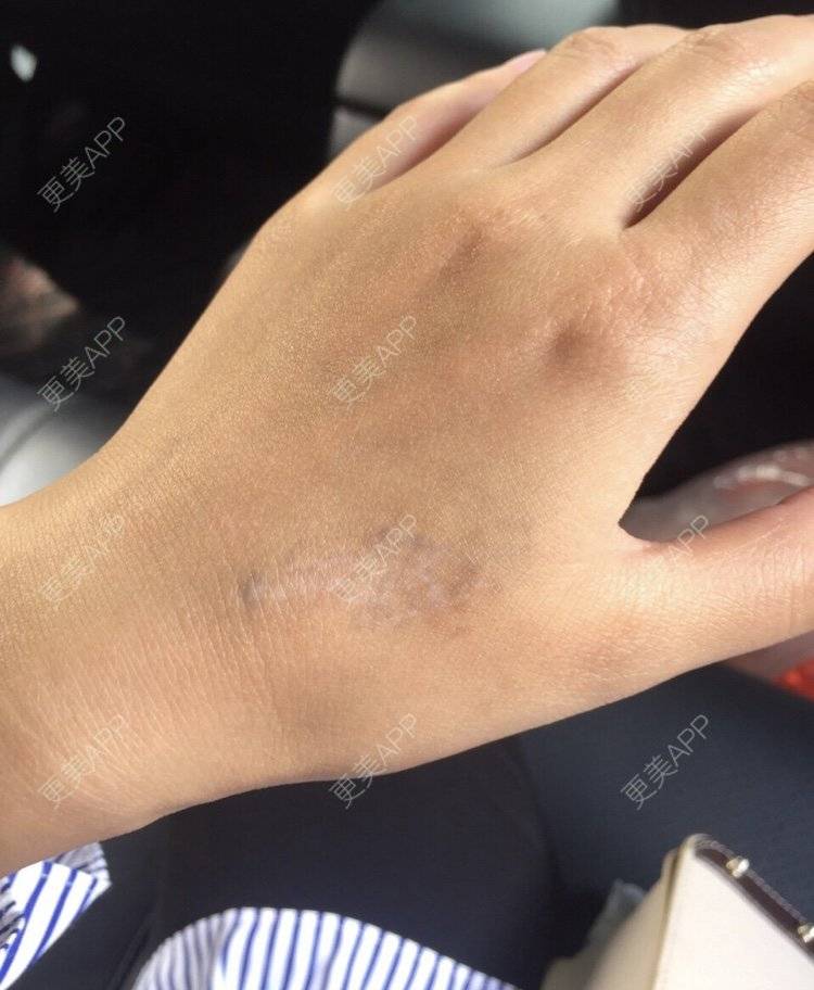 更美用户gmzv8sr1pi的激光洗纹身日记